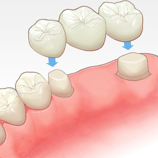 ブリッジ 奥歯 歯のブリッジは危険!? メリット・デメリット・費用を歯医者が徹底解説