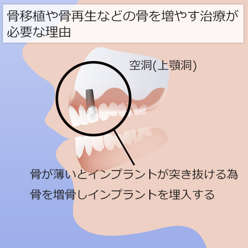 骨移植や骨再生などの骨を増やす治療が必要な理由 インプラントが上あごの上顎洞を突き抜けている図