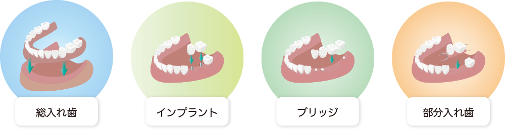 様々な歯の治療方法