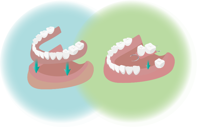部分入れ歯と総入れ歯