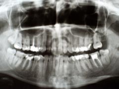 顎骨のレントゲン写真