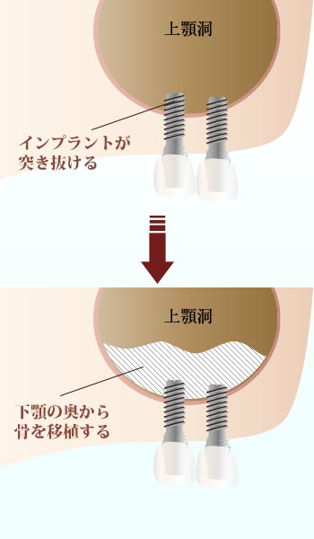 サイナスリストのイラスト