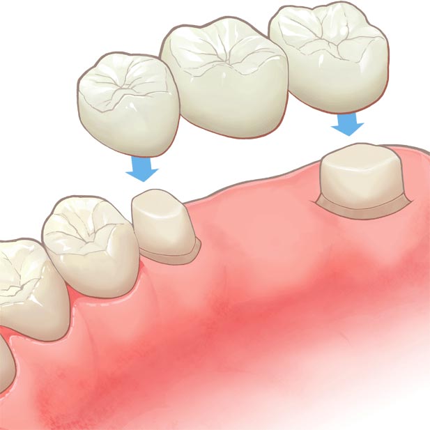 インプラントとブリッジの比較 健康な歯を守る 費用を抑える