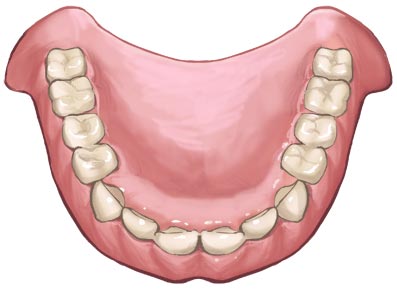 総入れ歯