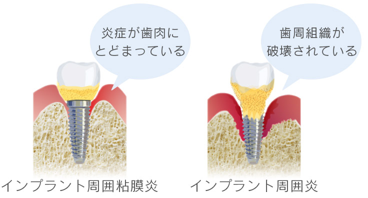 インプラント周囲粘膜炎