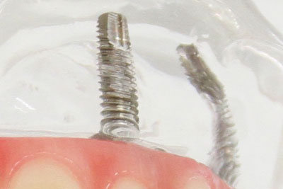 歯茎の模型に埋め込まれているチタン製のインプラント