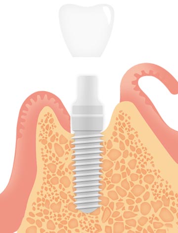 インプラント