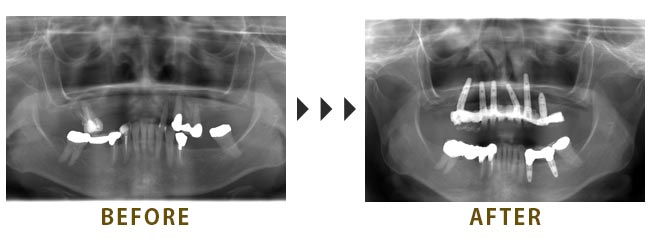 上顎に6本、左下に2本のインプラント埋入