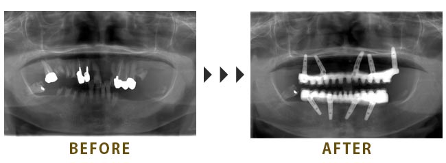 上5本、下4本のインプラントを埋入