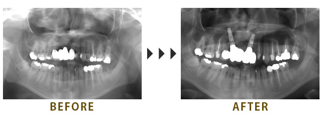 インプラントは必要最小限で治療