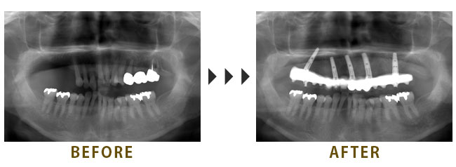 5本のインプラントを埋入