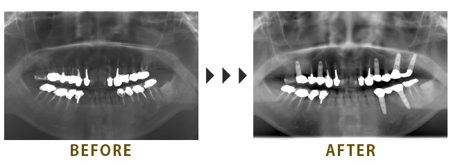 7本のインプラントを埋入