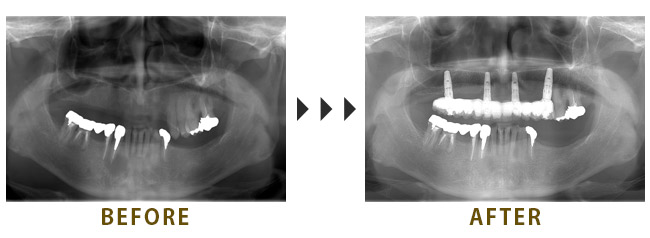 上4本のインプラントを埋入