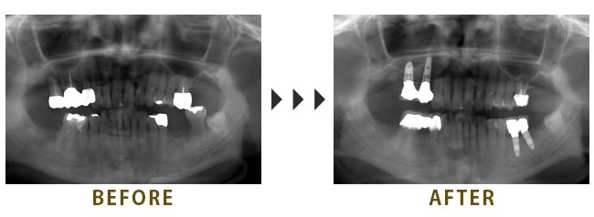 4本のインプラントを埋入