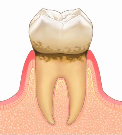 軽度歯周病の状態の歯と歯肉の状態