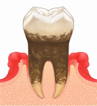 重度歯周病の症状