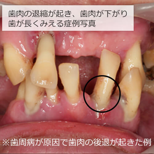 歯肉の退縮が起き、歯肉が下がり歯が長くみえる症例写真 ※歯周病が原因で歯肉の後退が起きた例