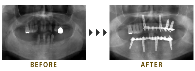 下顎 All on 4　上顎に4本のインプラントブリッジ治療