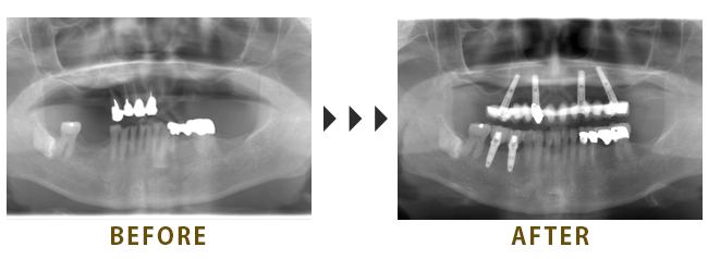 All on 4治療と右下に2本のインプラント埋入