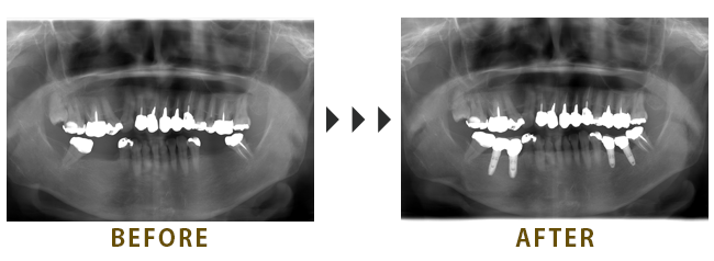 4本のインプラントを埋入