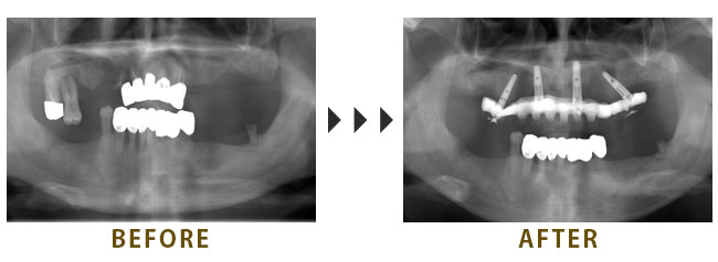 上顎の歯牙のAll on 4治療