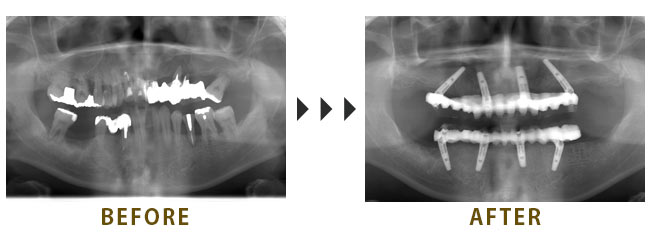 上下顎All on 4治療