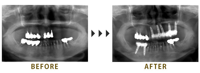 上顎に5本、右下に２本インプラントブリッジ