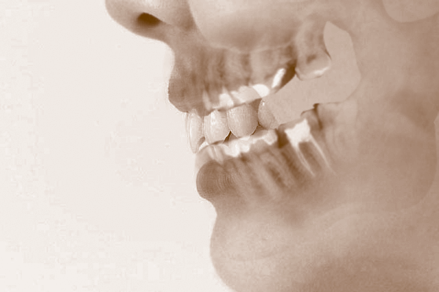 顎骨とインプラントのイメージ